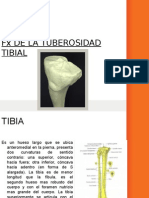 Fractura de La Tuberosidad de La Tibia