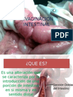 Invaginacion Intestinal