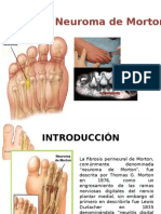 Neuroma de Morton