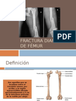 Fractura Diafisiaria de Fémur