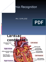 Approach To Arrythmia Recognition