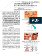 Endoscopic Insertion of Tympanostomy Tube in Children