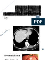 Tumores Hepaticos