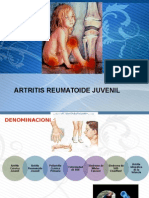 Artritis Reumatoide Juvenil