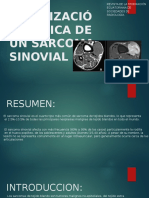 Sarcoma Sinovial