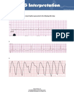 Identify The Heart Rhythm Represented in The Following EKG Strips