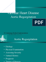 Aortic Regurgitation