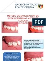 Extraccion Mediante Colgajo Incision