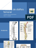 Fractura de Diáfisis Femoral