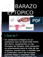 Embarazo Ectopico