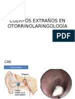 Cuerpos Extraños en Otorrinolaringología