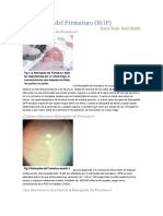 Retinopatía Del Prematuro