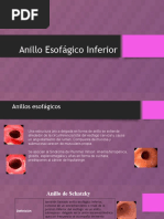 Anillo Esofágico Inferior 