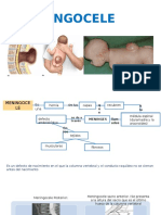 Meningocele y Mielomeningocele Hidrocefalio Meningitis