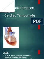 Pericardial Effusion