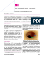 Granulomas Asociados Al Uso Prolongado Del Tubo de Traqueostomia