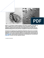 (Figure 4) (Figure 4) : 2. Portal Vein Stenosis