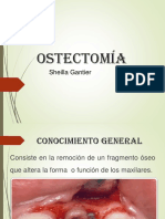 Ostectomía