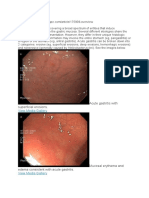 Medscape Gastritis