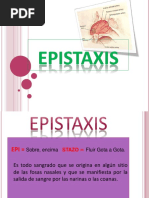 Epistaxis