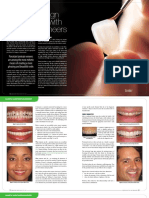 Smile Design Enhanced With Porcelain Veneers