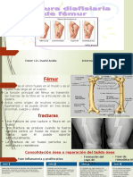 FX Diafisis Femoral