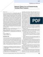 Hemisection A Treatment Option For An Endodontically Treated Molar With Vertical Root Fracture