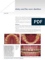 Worn Dentition and Direct & Indirect Composite Restoration