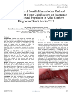 The Prevalence of Tonsilloliths and Other Oral and Maxillofacial Soft Tissue Calcifications On Panoramic