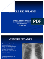 Neoplasia Maligna de Pulmon