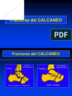 04 - Fracturas Del Calcaneo