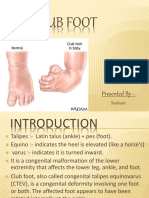 Clubfoot