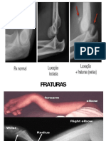 Estudos de Imagens Ortopédicas - Fraturas