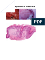 Queratosis Friccional