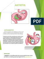 Gastritis 2