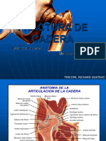 Fractura de Cadera