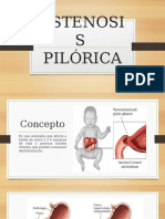 Estenosis Pilorica