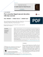 Post Extraction Lingual Mucosal Ulceration With Bone Necrosis