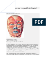 Paralisis Facial