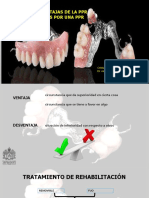 Ventajas y Desventajas de Protesis Remobible