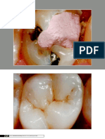 Endocrown Articulo