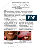 Hairy Leukoplakia As An Early Oral