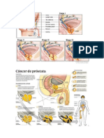 Cancer de Prostata