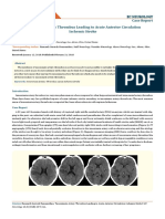 Cronicon: Case Report Innominate Artery Thrombus Leading To Acute Anterior Circulation Ischemic Stroke