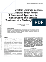 Splinted Porcelain Laminate Veneers With A Natural Tooth Pontic: A Provisional Approach For Conservative and Esthetic Treatment of A Challenging Case