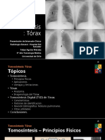 Tomosíntesis y Evaluación de Nódulos Pulmonares