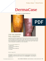 B. Caso Clinico. Turchin, I., & Barankin, B. 2006. Dermacase. Chronic Venous Insufficiency.