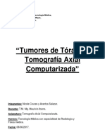 Tumores de Tórax TAC