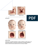 Labio Leporino y Paladar Hendido