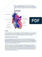 Patent Ductus Arteriosus New